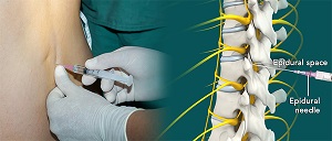 Epidural Spinal Injections
