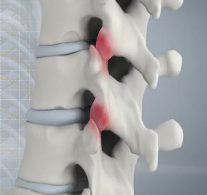 Spine Arthritis