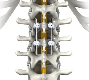 Thoracic Spine Fusion