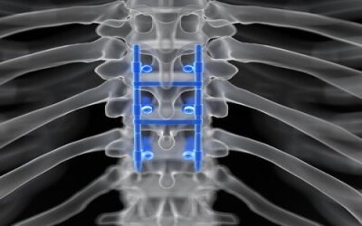 Erase Spinal Pain With Spinal Fusion Surgery