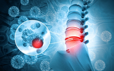 Spinal Tumors: Diagnosis, Treatment, and Recovery