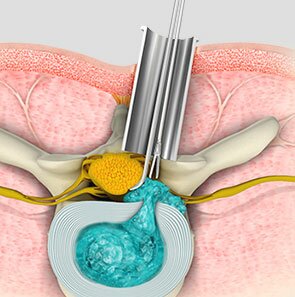 Minimally Invasive Spine Surgery