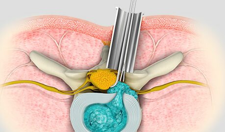 Minimally Invasive Spine Surgery