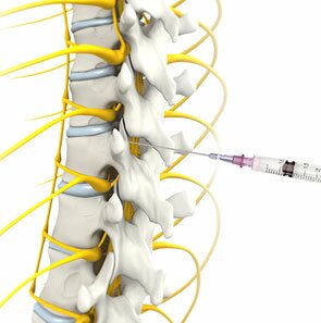 Nonsurgical Spine Treatments