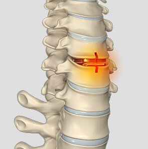 Revision Spine Surgery