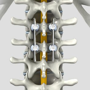 Spinal Fusion Surgery